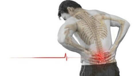 Die Wirbelverlagerung verursacht meist starke und häufig auftretende Rückenschmerzen