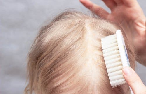 Seborrhoische Dermatitis ist nicht auf mangelnde Hygiene zurückzuführen