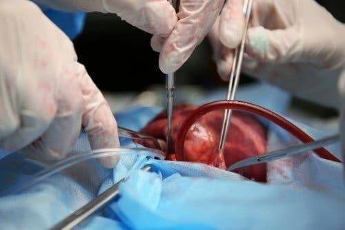 Ein ventrikuläres Hilfsgerät stellt eine Option zur Herztransplantation dar