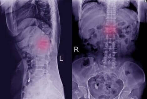 Röntgenaufnahmen sind die wichtigsten Test bei der Erkennung dieses Leidens