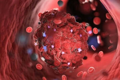 Ein Thrombus