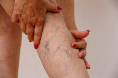 Phlebitis: Beschreibung, Symptome und Behandlung