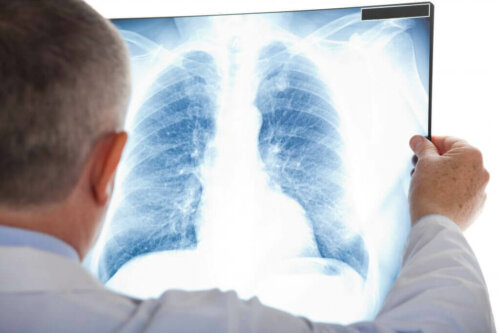 Diagnose Atelektase