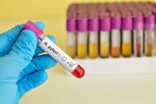 Ein positiver H. pylori-Test in einem Fläschchen zur Diagnose von Magen- und Zwölffingerdarmgeschwüren