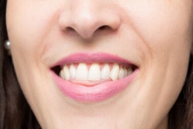 Was ist ein offener Biss und wie wird er korrigiert?