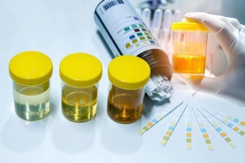 Um diesen Zustand zu diagnostizieren, sollte der Arzt eine Blut- und Urinuntersuchung anfordern