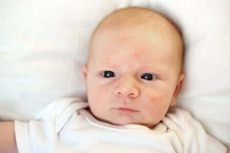Babyakne