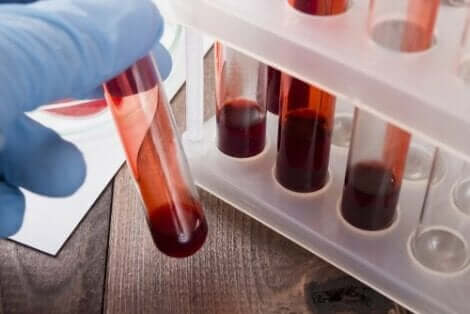 Septische Arthritis