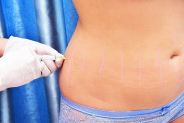 Was ist Lipotherapie und wofür wird sie angewendet?