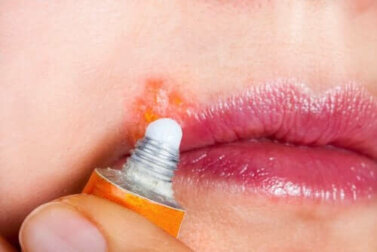 Oraler Herpes: Symptome und Behandlung