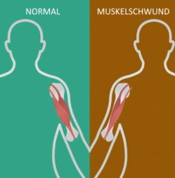 Neuromuskuläre Erkrankungen: Wissenswertes