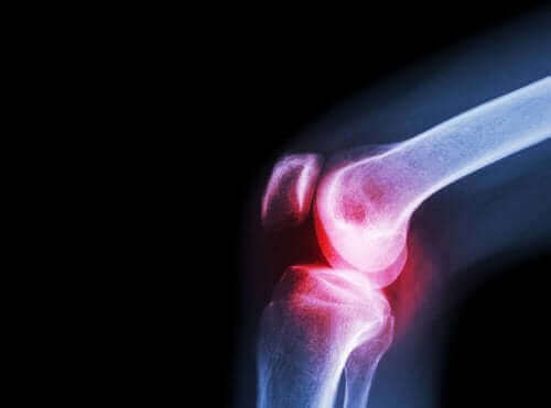 Septische Arthritis: Ursachen, Symptome und Behandlung