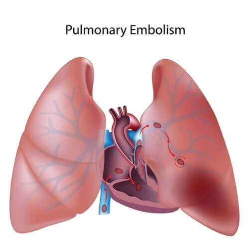 Ursachen, Symptome und Behandlung der pulmonalen Thromboembolie