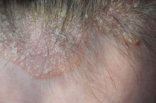 Psoriasis der Kopfhaut – Symptome und Behandlung