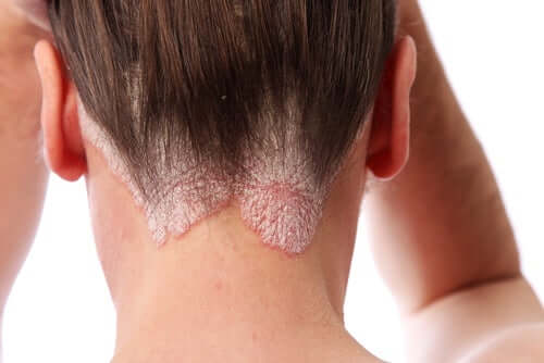 Psoriasis der Kopfhaut - Nacken