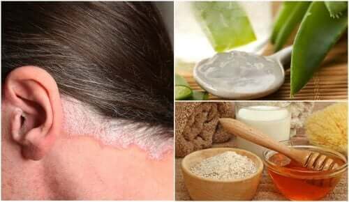 Psoriasis der Kopfhaut - Heilmittel