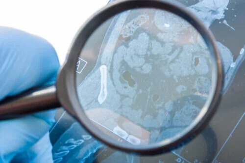 Was ist eine gastrointestinale Fistel und wie entsteht sie?