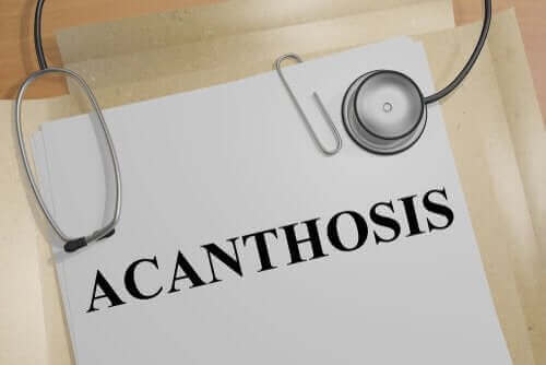 Die Ursachen von Acanthosis nigricans