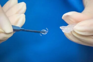 Intraokulare Linsenoperation: Wann ist sie notwendig?