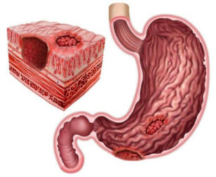 Magengeschwüre und Helicobacter pylori