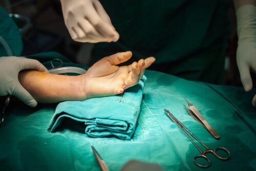 Fingeramputation