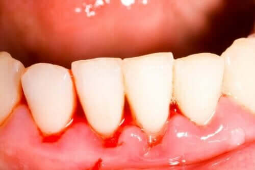 Entzündetes Zahnfleisch aufgrund von Gingivitis