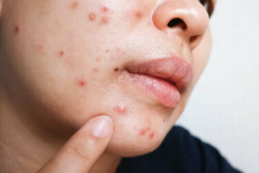 Isotretinoin bei Akne: Nutzen und Nebenwirkungen