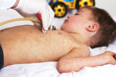 Das Syndrom der verbrühten Haut oder das Lyell-Syndrom: Ursachen und Symptome