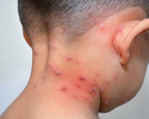 Syndrom der verbrühten Haut - Kind mit Pocken