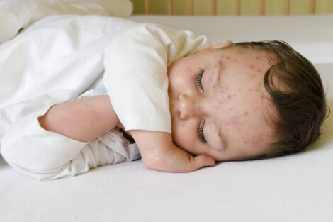 Ramsay-Hunt-Syndrom: Was ist das? - Besser Gesund Leben