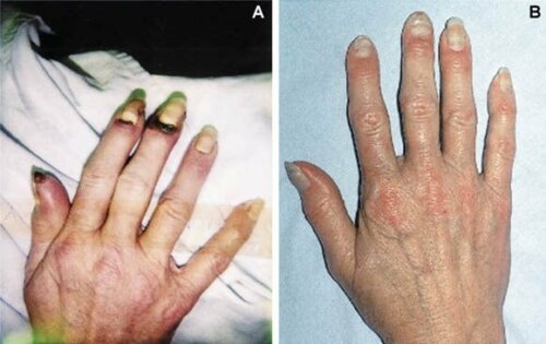 Morbus Buerger: Ursachen, Symptome und Behandlung