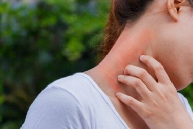 Dermatitis und Kortikosteroide: Wie hängen sie zusammen?