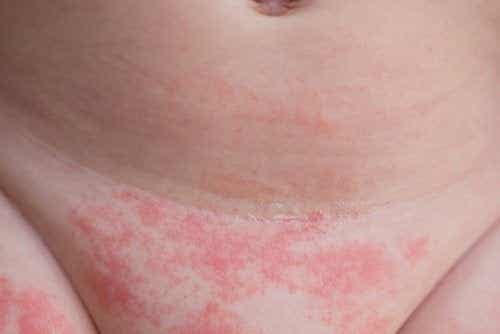 Dermatitis und Kortikosteroide