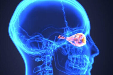Neuromyelitis optica oder Devic-Syndrom: Was ist das?