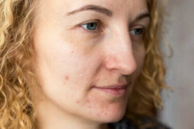 Wie du ein Melasma verhindern kannst