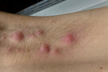 Kann die Ernährung eine Hidradenitis suppurativa verbessern?