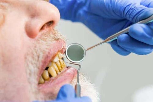 Rauchermelanose - vergilbte Zähne - Zahnarzt