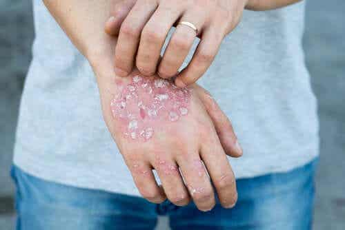 Frau mit Psoriasis-Ausschlag