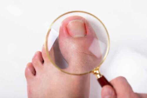Es ist besser, einer Nagelpilzinfektion vorzubeugen, als sie zu behandeln
