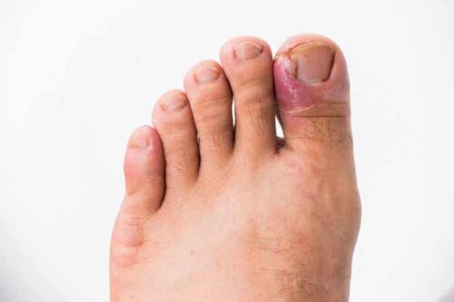 Ältere Menschen haben ein höheres Risiko, Nagelpilzinfektionen zu entwickeln