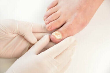 Nagelpilzinfektion: 7 Tipps zur Vorbeugung