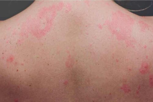 Bei der Einnahme von Traubensilberkerze kann es zu dermatologischen Reaktionen kommen