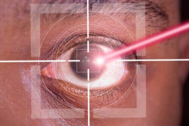 LASIK-Operation: Die Vor- und Nachteile