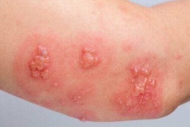 Bullöses Pemphigoid: Ursachen, Symptome und Behandlung