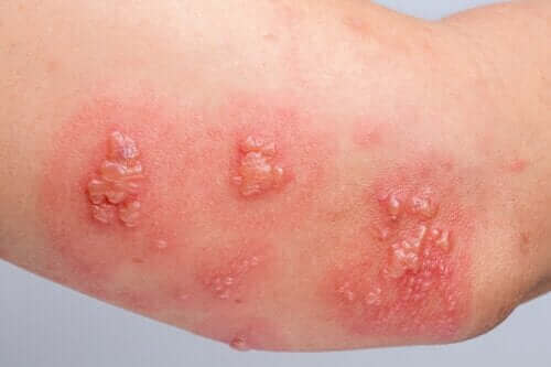 Bullöses Pemphigoid: Ursachen, Symptome und Behandlung