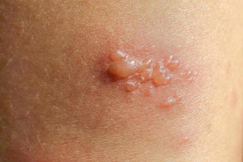 Ein bullöses Pemphigoid ist eine sehr seltene Autoimmunerkrankung der Haut