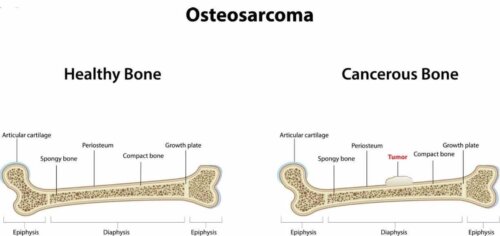 Osteosarkome bei Kindern-Schaubild