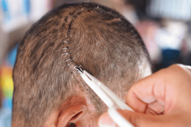 Was ist eine Kraniotomie und wann ist sie erforderlich?