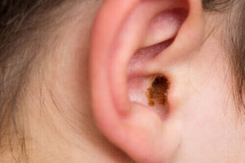 Merkmale einer Ohrenschmalzverstopfung