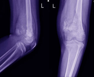Osteosarkome bei Kindern: Die Merkmale und Symptome